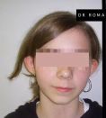 Dr Romain Viard - Correction d’oreilles décollées par hypertrophie de conque et défaut de placature de l’anthélix. Chirurgie sous anesthésie générale. Résultat à 10 jours.