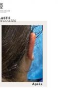 Otoplastie (Chirurgie esthétique des oreilles) - Cliché avant