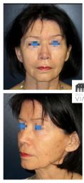 Lifting du visage - Lifting cervico facial avec lipostructure chez une femme de 76 ans. Effet recherché obtenu avec redéfinition de l’ovale du visage et redinamisation des joues.
