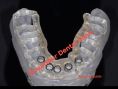 Implants dentaires - Cliché avant - Dr Bouattour Mohamed Amine