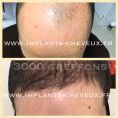 Greffe de cheveux - Nouvelle technique sans cicatrice, micro greffe FUE, implantation naturelle.
implants-cheveux.fr