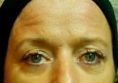 Lifting non chirurgical (Exilis) - Cliché avant - RS Esthétique - Centre d’amincissement & remodelage de la silhouette anti-âge visage et corps sans chirurgie