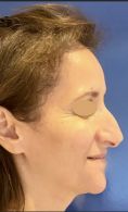 Rhinoplastie - Cette patiente souhaitait un nez naturel - Nous avons procédé à une réduction de la bosse, un affinement et un repositionnement de la pointe du nez.