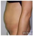 Liposuccion - Résultat à 6 mois d’une abdominoplastie avec cure de diastasis des muscles grands droits de l’abdomen.