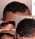 Greffe de cheveux - Cliché avant - Phoenix Hair Center