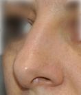 Rhinoplastie - Restructuration de la pointe du nez. Modification des cartilages alaires et de la projection