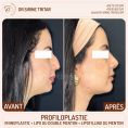 Rhinoplastie - Cliché avant - Dr Sirine Tritar