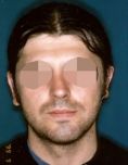 Otoplastie (Chirurgie esthétique des oreilles) - Cliché avant - Dott. Andrea La Padula M.D.