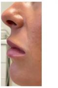 Augmentation des lèvres (acide hyaluronique) - Cliché avant - Dr Alexandre Krassoulia-Vronsky