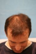Traitements de la chute des cheveux - résultat à 6 mois, FUT, une grande séance de 5000 cheveux