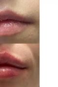 Augmentation des lèvres - Cliché avant - Docteur Pierre Laur