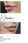 Augmentation des lèvres (acide hyaluronique) - Cliché avant - Dr Christophe Desouches
