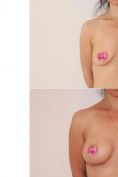 Augmentation mammaire (Implants mammaires) - Cliché avant - Dr Xavier Tenorio