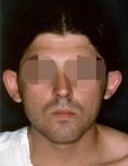 Otoplastie (Chirurgie esthétique des oreilles) - Cliché avant - Dott. Andrea La Padula M.D.
