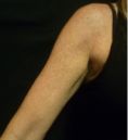 Lifting des bras - Aujourd’hui, la technologie permet de faire pénétrer l’acide hyaluronique SANS AIGUILLE NI INJECTION ! Cette technique de revitalisation 100% naturelle permet de traiter la peau en surface et en profondeur.