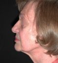 Dr Philippe Garcia - Femme, 70 ans, résultat à 3 mois post-opératoire.
Technique : lifting profond cervico-facial, avec suspension du SMAS