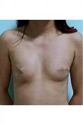 Augmentation mammaire (Implants mammaires) - Cliché avant - Dr Achraf Daoud
