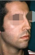 Rhinoplastie - Cliché avant - Dott. Andrea La Padula M.D.
