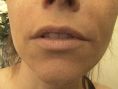 Augmentation des lèvres - Cliché avant - Dr Christine Luneau