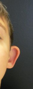 Otoplastie (Chirurgie esthétique des oreilles) - Cliché avant - Dr Eric BONAFOS