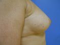 Lipofilling mammaire - Cliché avant - Dr Fabrice Poirier