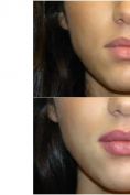 Augmentation des lèvres - Cliché avant - Dr Xavier Tenorio