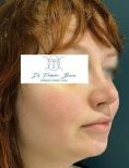 Dr Frédéric Barere - L’affinement du nez est visible sur les coupes de face, la diminution de la bosse sur celles de profil !
Résultat à 6 mois.