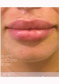 Augmentation des lèvres (acide hyaluronique) - Cliché avant - Dr Catherine Eychenne