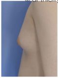 Lipofilling ou autogreffe de tissu graisseux - Cliché avant - Dr Thierry Lemaire