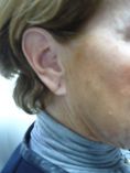 Otoplastie (Chirurgie esthétique des oreilles) - Cliché avant - Dr Laurent Benadiba M.D