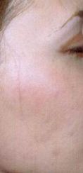Traitement acné - laser - Cliché avant - Dr Xavier Tenorio