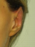 Otoplastie (Chirurgie esthétique des oreilles) - Cliché avant - Dr Nicolas Froget