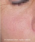 Suppression des veines par laser (taches de naissances, rougeurs) - couperose joue,  résultat après une séance de laser