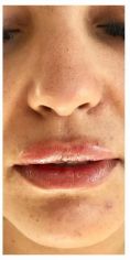 Augmentation des lèvres (acide hyaluronique) - Cliché avant - Dr Bertrand Delaoustre