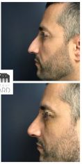 Dr Romain Viard - Rhinoplastie réparatrice chez un homme se plaignant d’une déviation du nez et d’une bosse. A noter que la pointe a été traitée dans le même temps pour harmoniser le résultat. Résultat à 3 mois.