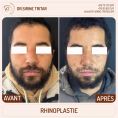 Rhinoplastie - Cliché avant - Dr Sirine Tritar