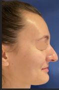 Rhinoplastie - Cette patiente souhaitait un nez naturel - Nous avons procédé à une réduction de la bosse, un affinement et un repositionnement de la pointe du nez.