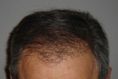 Greffe de cheveux - Cliché avant - Dr Jean-Luc COHEN