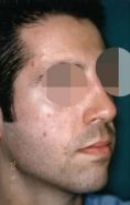 Rhinoplastie - Cliché avant - Dott. Andrea La Padula M.D.
