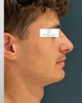 Dr Frédéric Barere - Résultat à 6 mois ostéotomie avancée mandibulaire