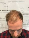 Greffe de cheveux - Cliché avant - Dr Fares Seffen