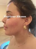 Docteur Hayet Zitoun Esthétique - La patiente a bénéficié de séances de PRP
Full filler face remodelage par lipodissolution