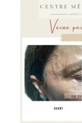 Suppression des veines par laser (taches de naissances, rougeurs) - Cliché avant - Dr Catherine de Goursac