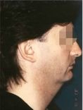 Liposuccion - Cliché avant - Dott. Andrea La Padula M.D.