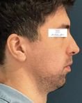 Génioplastie - Chirurgie esthétique du menton - la génioplastie peut être réalisée :
-Seule
-En complément d’une ostéotomie des mâchoires
-En complément d’une rhinoplastie (profiloplastie)
-En complément de prothèses d’angles mandibulaires (virilisation faciale)