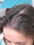 Traitements de la chute des cheveux - résultat à huit mois , FUT , 3500 cheveux