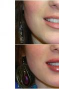 Augmentation des lèvres - Cliché avant - Dr Xavier Tenorio