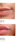Augmentation des lèvres - Cliché avant - Dr Hai Seroussi