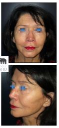 Lifting du cou - Lifting cervico facial avec lipostructure chez une femme de 76 ans. Effet recherché obtenu avec redéfinition de l’ovale du visage et redinamisation des joues.