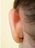 Otoplastie (Chirurgie esthétique des oreilles) - Cliché avant - Clinique Dr. Wim Danau